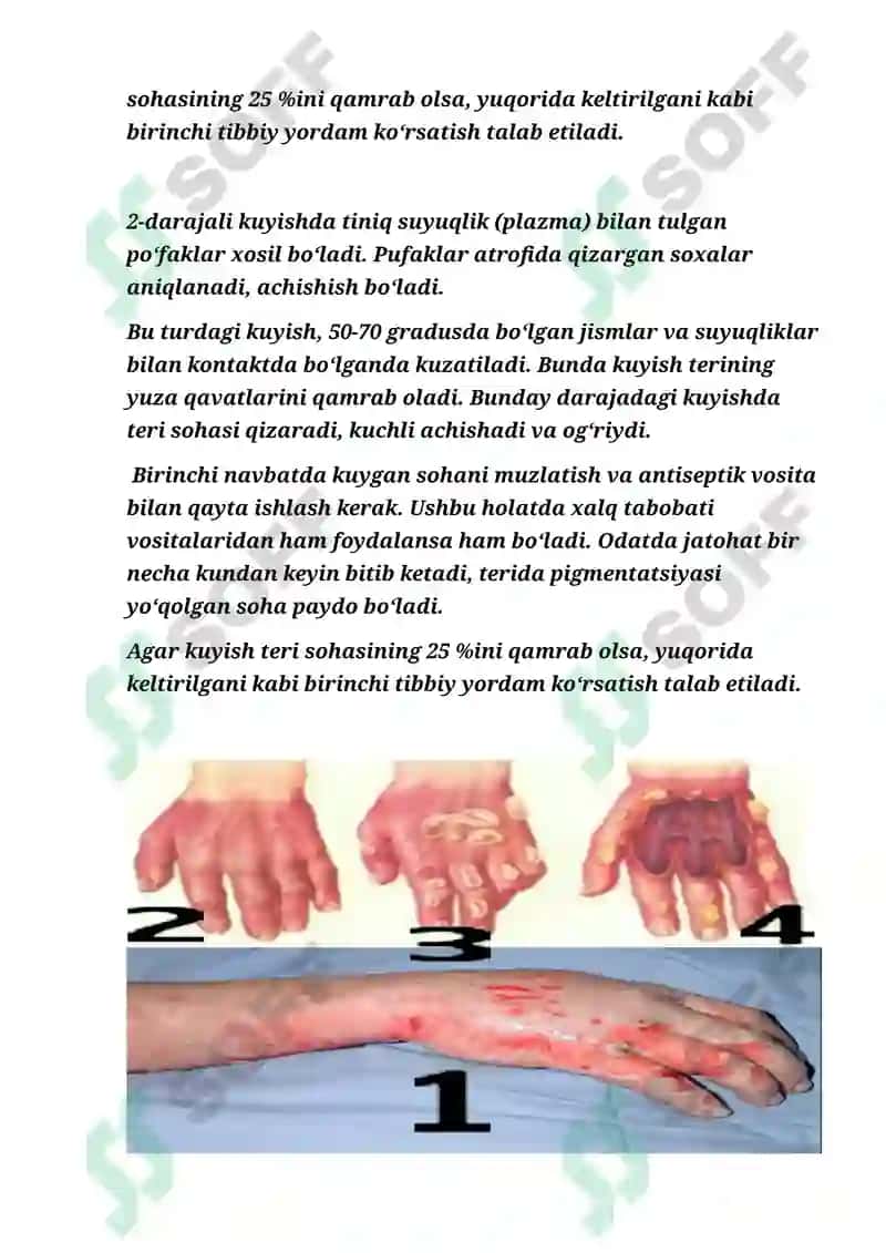 KUYISH KASALLIGI VA DARAJALARI.BEMORLARNING PARVARISHI 6