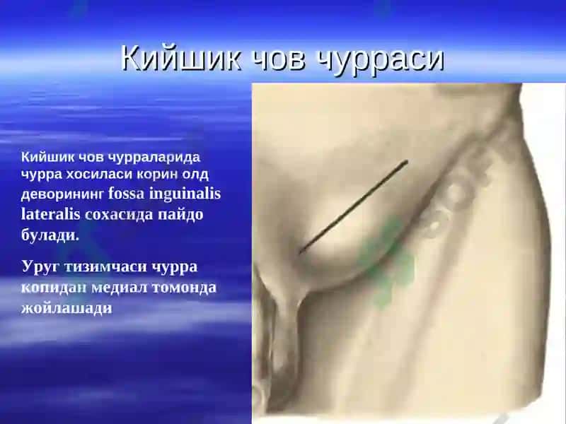 Корин олд девори касаликлари корин олди мускуллари аплозияси 6