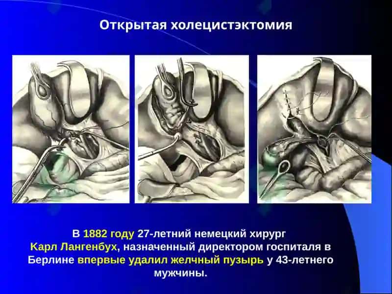 Постхолецистэктомический синдром 6