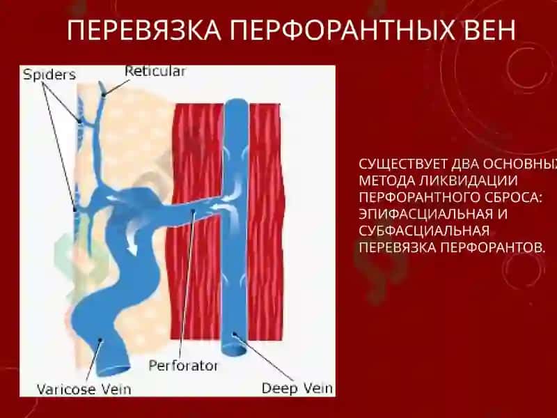 СОВРЕМЕННЫЕ МЕТОДЫ ХИРУРГИЧЕСКОГО ЛЕЧЕНИЯ ВАРИКОЗНОЙ БОЛЕЗНИ НИЖНИХ КОНЕЧНОСТЕЙ 6