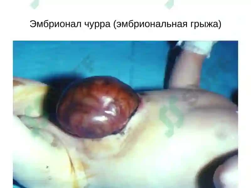 Қорин парда кин усимтасининг тугма ривожланиш нуксонлари ва аномалиялар ва чурралар 6