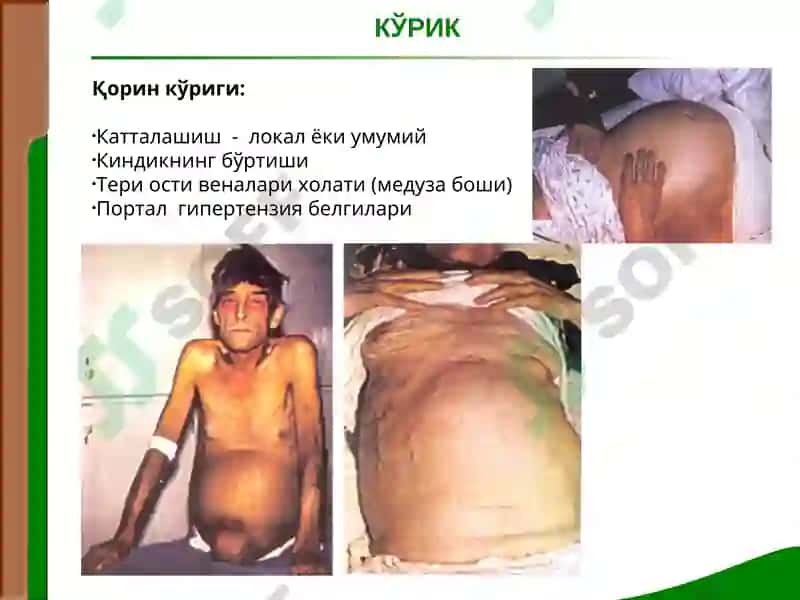 Жигар ва ўт йуллари касалликлари билан касалланган беморларни текшириш 6
