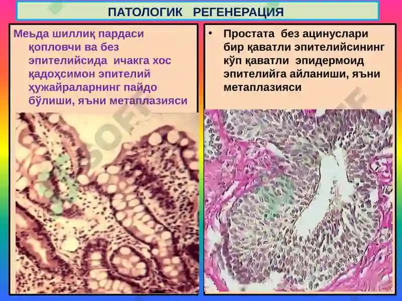 Мосланиш-ўрин алмашиниш жараёнлари. Гипертрофия, атрофия, гиперплазия, метаплазия, дисплазия 6