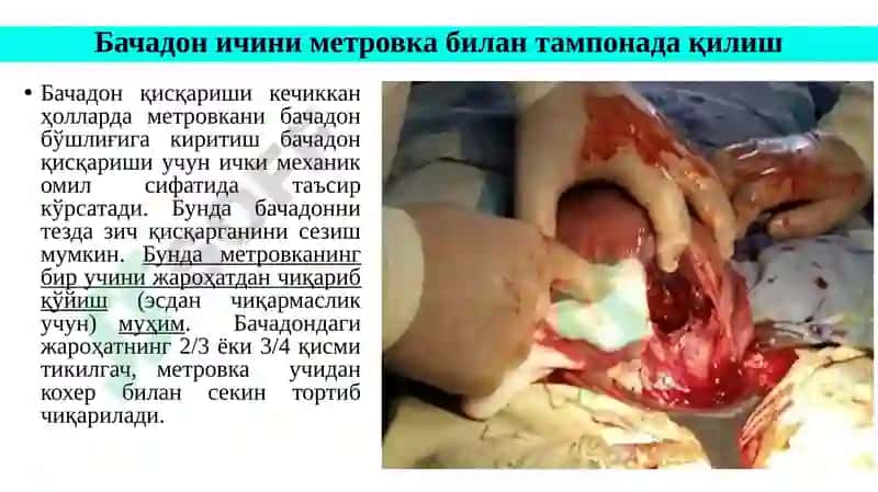 Қон кетишини баҳолаш ва камайтириш чоралари 7
