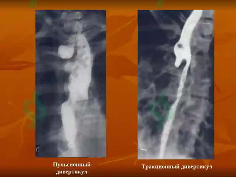 Лучевая диагностика заболеваний желудочно-кишечного тракта 7