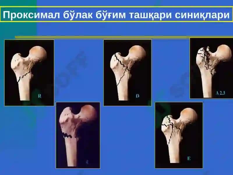 Сон,тизза,болдир ваоёқ панжа шикастлари 7