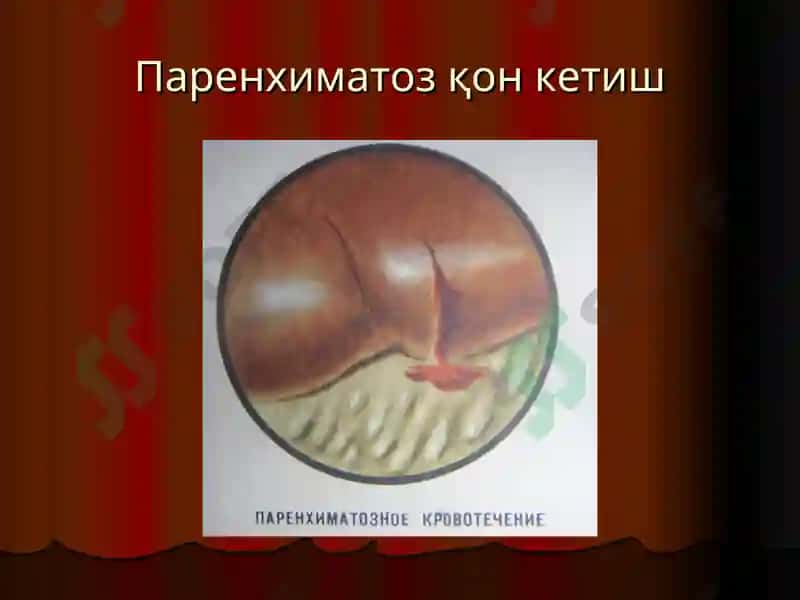 “Қон кетиш ва уни тўхтатиш усуллари” маъруза 7