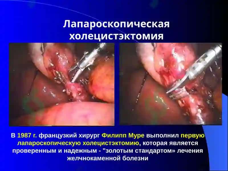 Постхолецистэктомический синдром 7