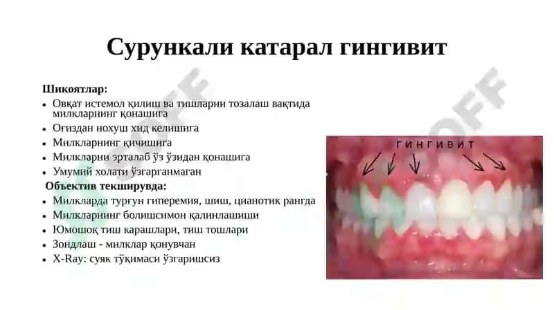Гингивитлар 7