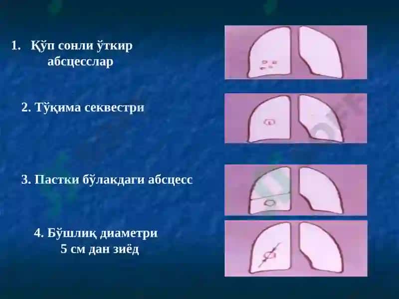 Ўпка сурункали носпецифик йирингли касалликлари 7