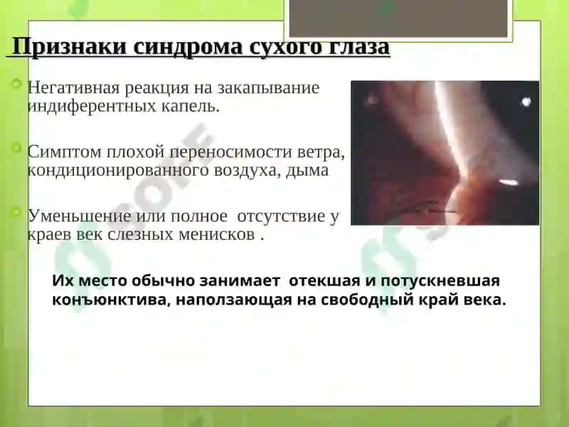 Синдром сухого глаза 7
