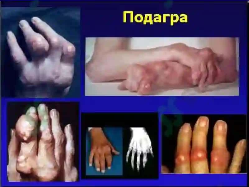 Буғим синдромини таққослама ташхиси ва умумий амалиёт шифокори тактикаси 7