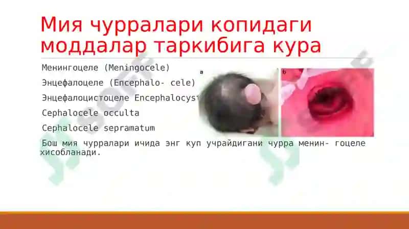 Bosh miya va orqa miyaning tug’ma rivojlanish nuqsonlari 7