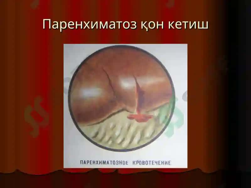 Қон кетиш ва уни тўхтатиш усуллари 7