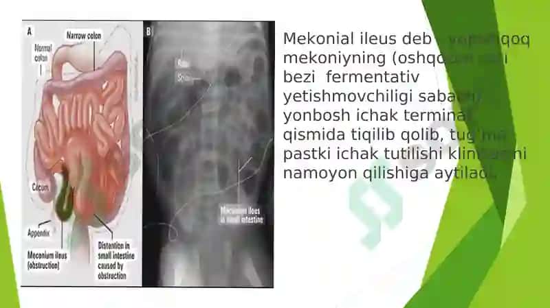 Pastki ichak tutilishlari 7