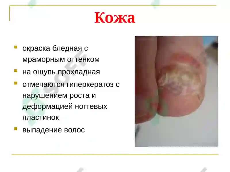 Хронические облитерирующие заболевания артерий 7