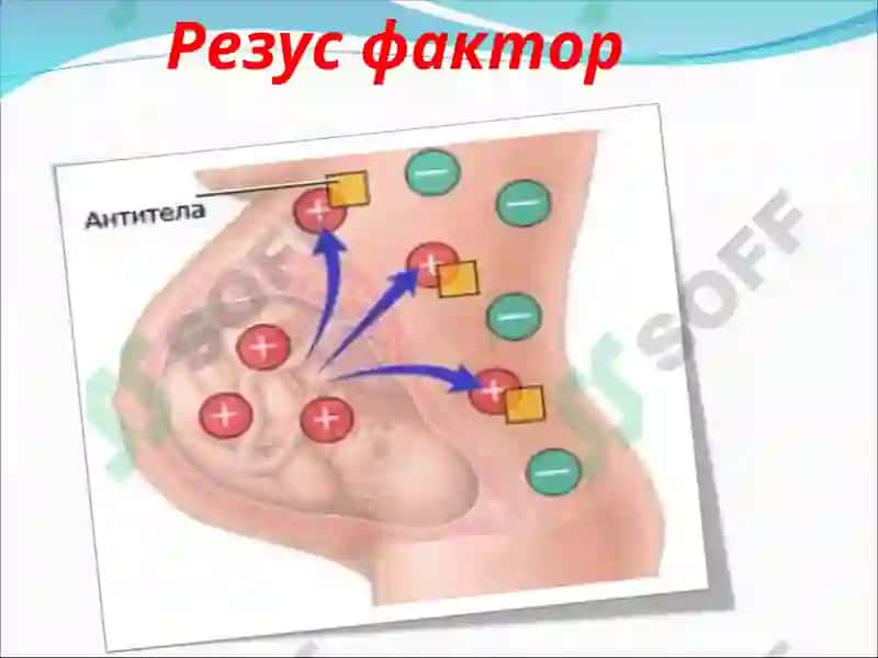 Резус фактор в акушерстве. иммуноконфликтная беременность: Гемолитическая болезнь плода 7