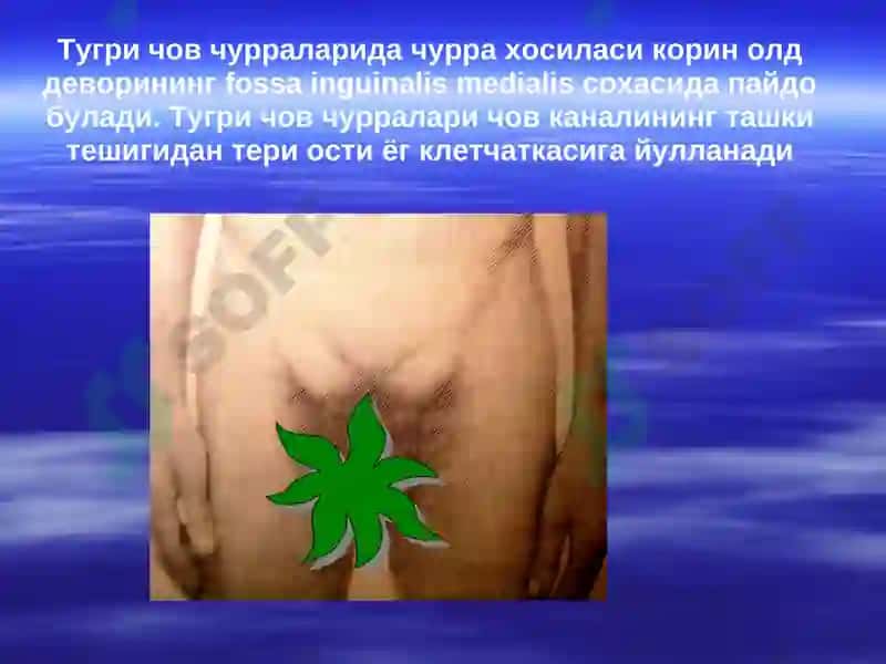 Корин олд девори касаликлари корин олди мускуллари аплозияси 7