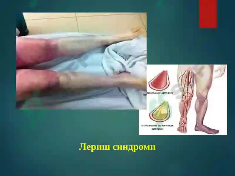 Оёқ артериялари сурункали облитерацияловчи касалликларини учрашфоизи 7