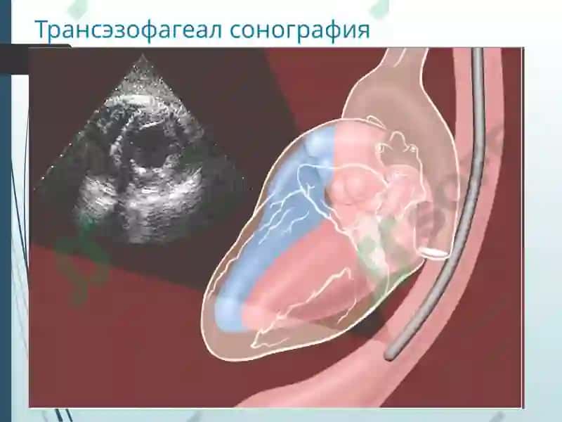Юрак касалликларини нур ташхиси 7