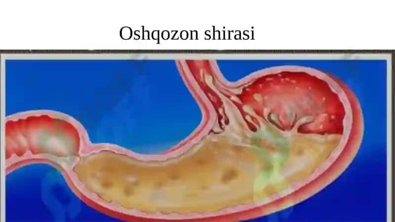 Oshqozon suyuqligi tashhisining klinik ahamiyati. Giperatsid holatlarda va oshqozon-ichak yara kasal 7