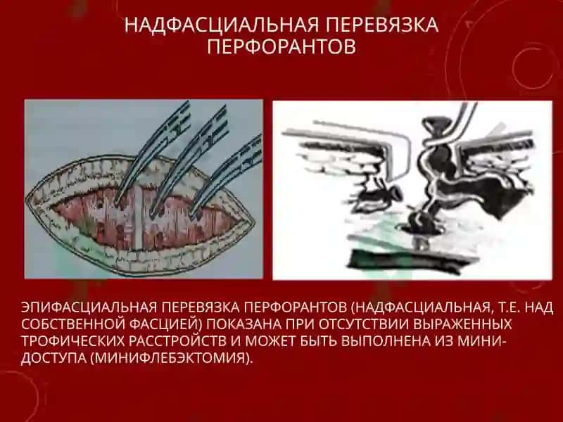 СОВРЕМЕННЫЕ МЕТОДЫ ХИРУРГИЧЕСКОГО ЛЕЧЕНИЯ ВАРИКОЗНОЙ БОЛЕЗНИ НИЖНИХ КОНЕЧНОСТЕЙ 7