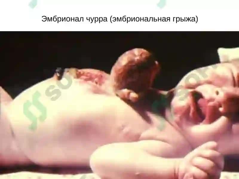 Қорин парда кин усимтасининг тугма ривожланиш нуксонлари ва аномалиялар ва чурралар 7