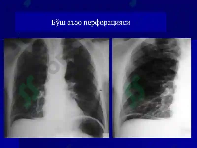 Ошқазон ичак касалликларида нур текшириш усуллари 7