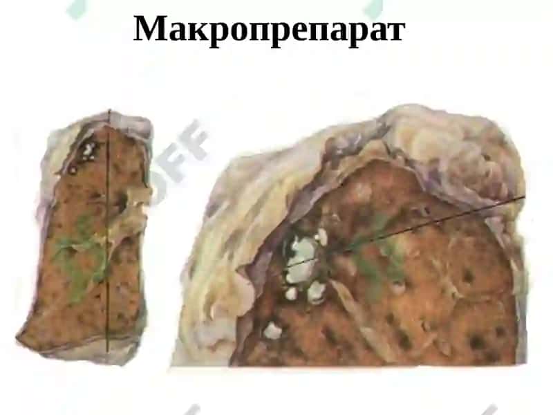 Ўчоқли, яллиғланган туберкулези ва ўпка туберкулемаси 7
