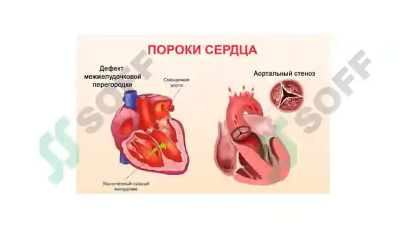 пороки сердца 8