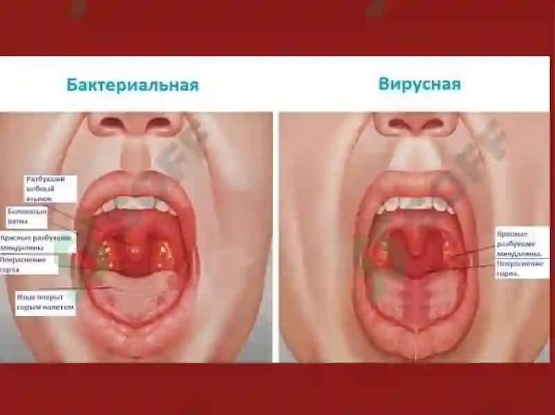 Anginalar, Atipik Pnevmoniya va Diareyalar 8