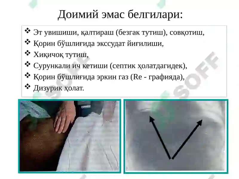 Ўткир перитонит 8
