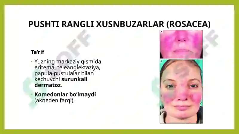 Seboreya. Pushti rangli xusnbuzarlar. Chaqaloqlarning yiringli  kasalliklari. Layell va Stivens-Djonson sindromlari 8