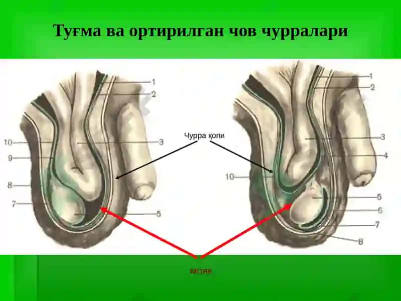 Чов, сон, киндик ва қорин оқ чизиғи чурралари 8