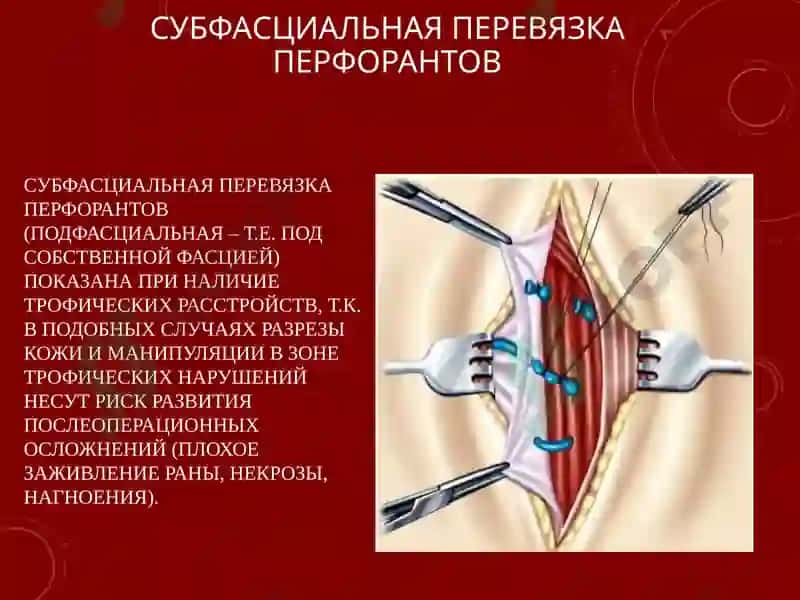 СОВРЕМЕННЫЕ МЕТОДЫ ХИРУРГИЧЕСКОГО ЛЕЧЕНИЯ ВАРИКОЗНОЙ БОЛЕЗНИ НИЖНИХ КОНЕЧНОСТЕЙ 8