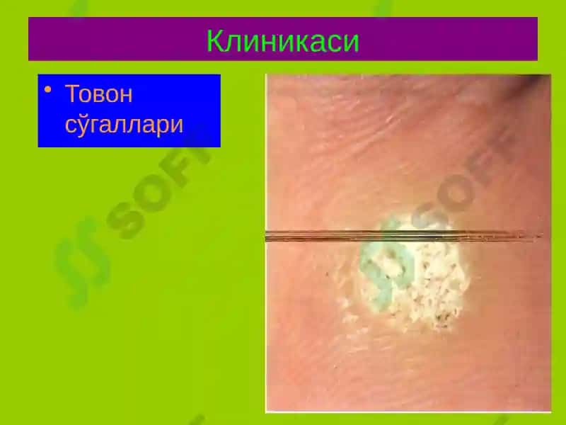 Терининг вирусли касалликлари 8
