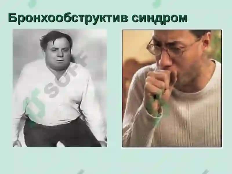 НАФАС ОЛИШ ТИЗИМИ КАСАЛЛИКЛАРИДА АСОСИЙ КЛИНИК СИНДРОМЛАР 8