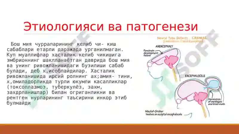 Bosh miya va orqa miyaning tug’ma rivojlanish nuqsonlari 8
