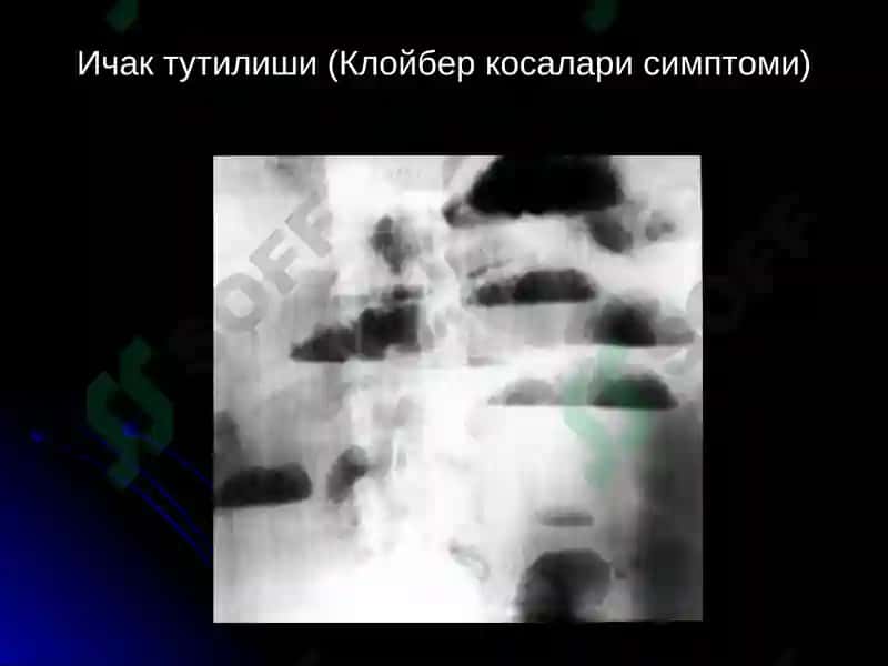Ошкозон-ичак касалликларининг нур ташхиси 8