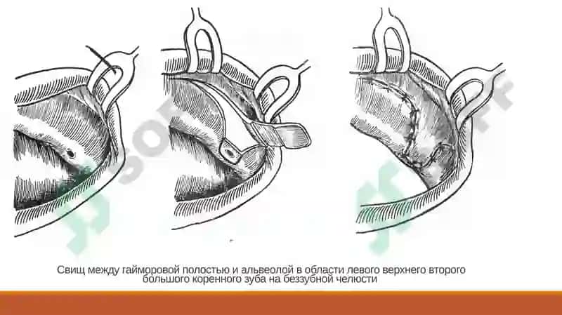 СПОСОБЫ ХИРУРГИЧЕСКОГО ЗАКРЫТИЯ СООБЩЕНИЯ МЕЖДУ ГАЙМОРОВОЙ ПАЗУХОЙ И АЛЬВЕОЛОЙ 8