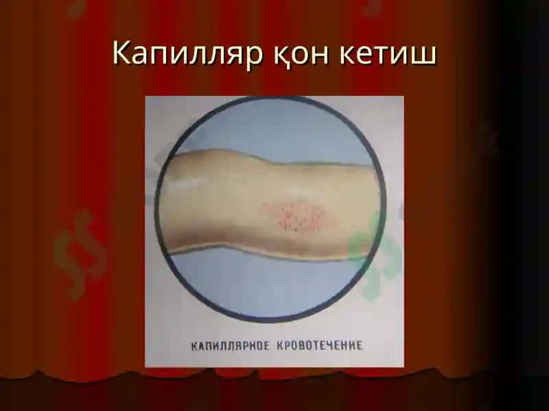 “Қон кетиш ва уни тўхтатиш усуллари” маъруза 8