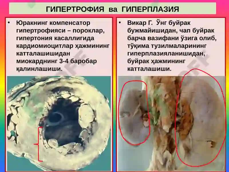 Мосланиш-ўрин алмашиниш жараёнлари. Гипертрофия, атрофия, гиперплазия, метаплазия, дисплазия 8