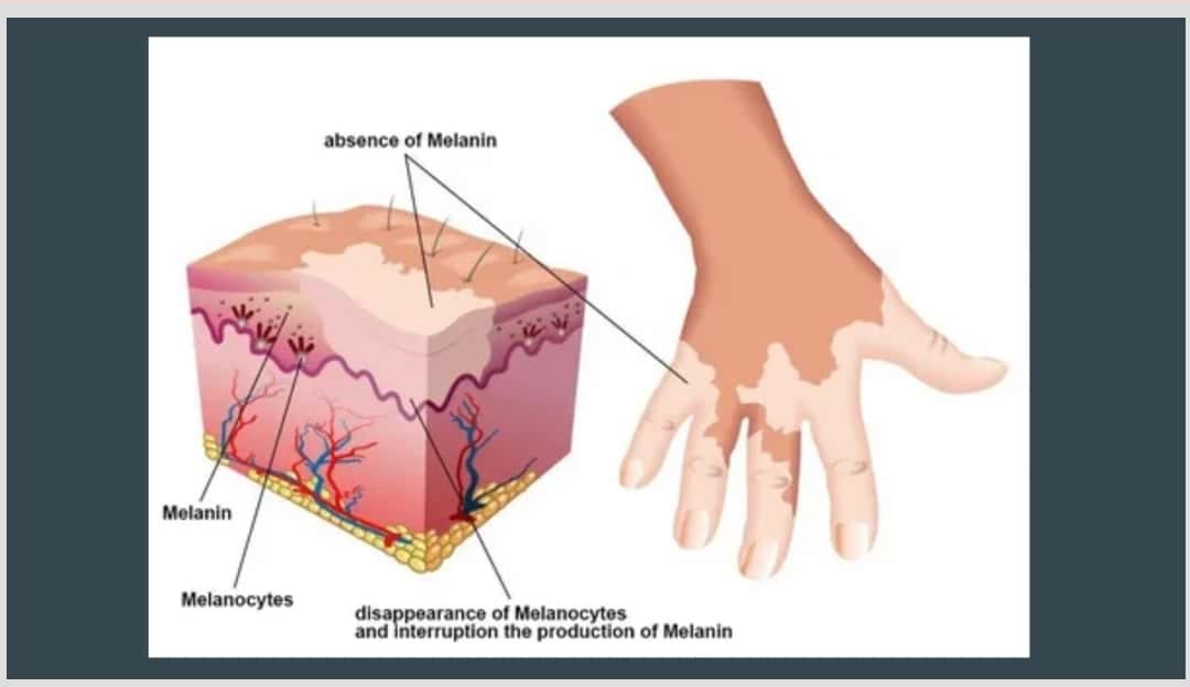Vitiligo