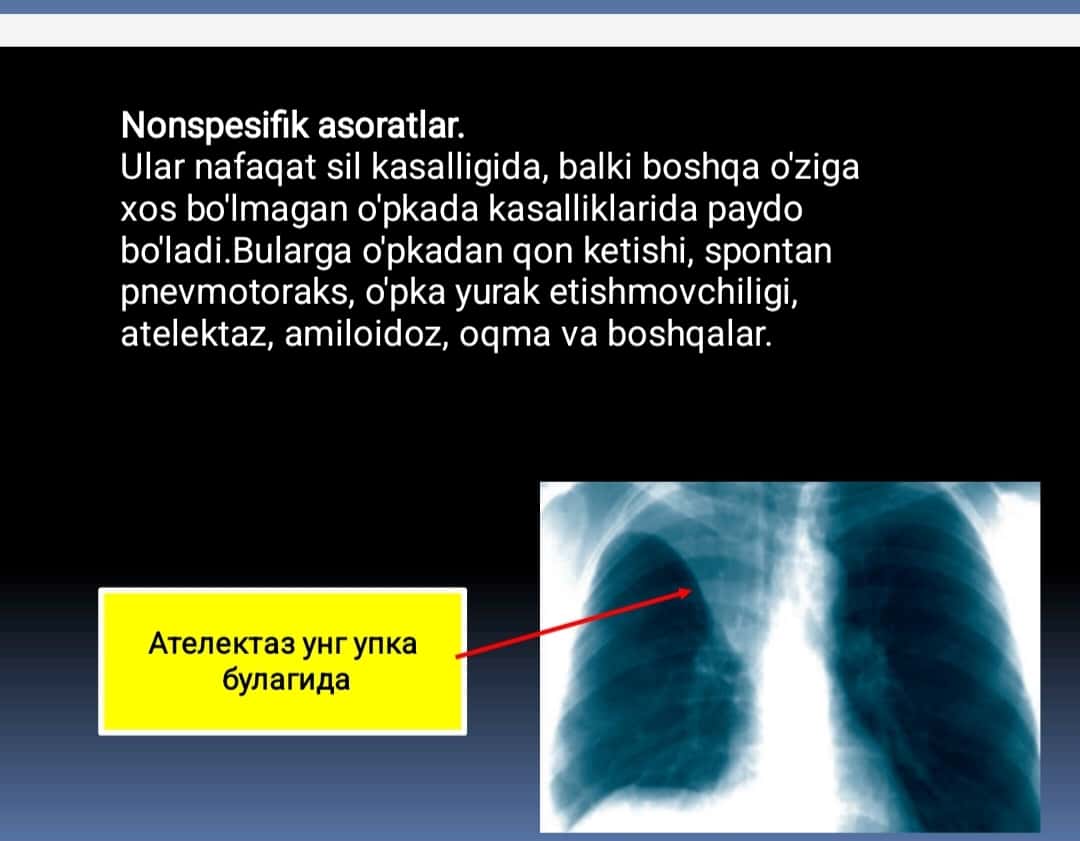 Oʻpka tuberkulyozi asoratlari. Tuberkulyoz bilan kasallangan bemorlarda nafas yetishmovchiligi