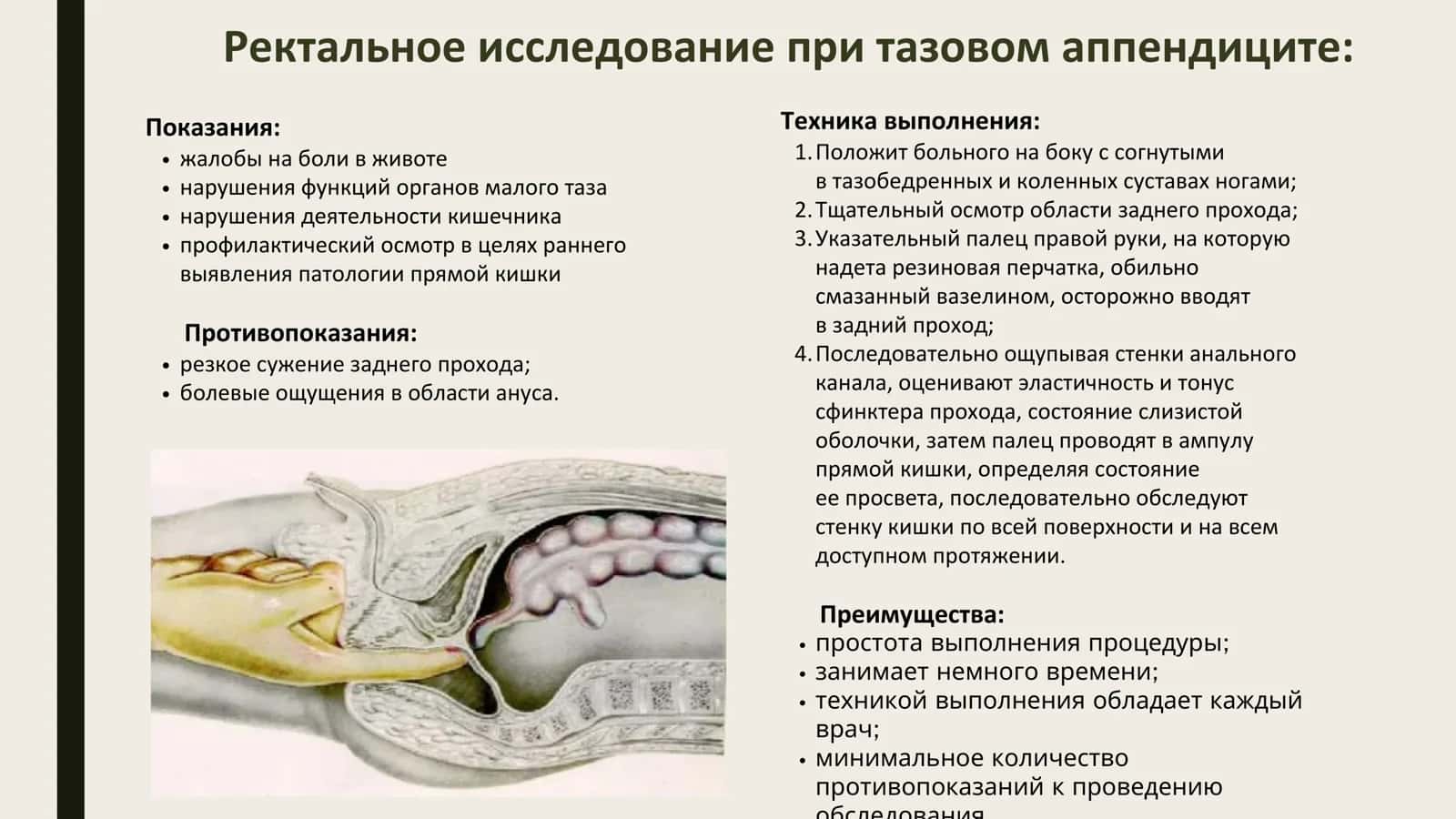 Ректальное исследование при тазовом аппендиците