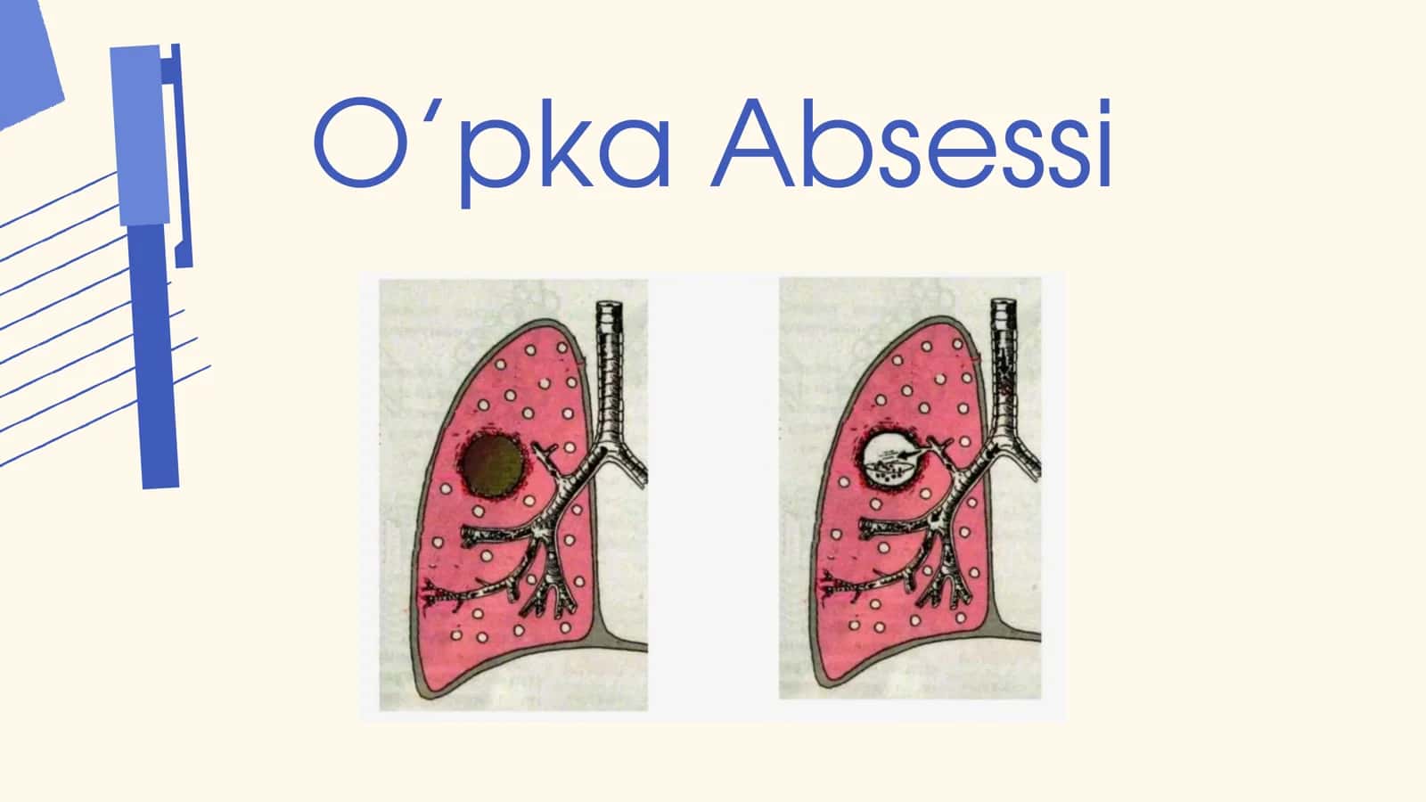 O'pka absessi