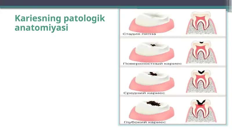 Kariesning patologika anatomiyasi