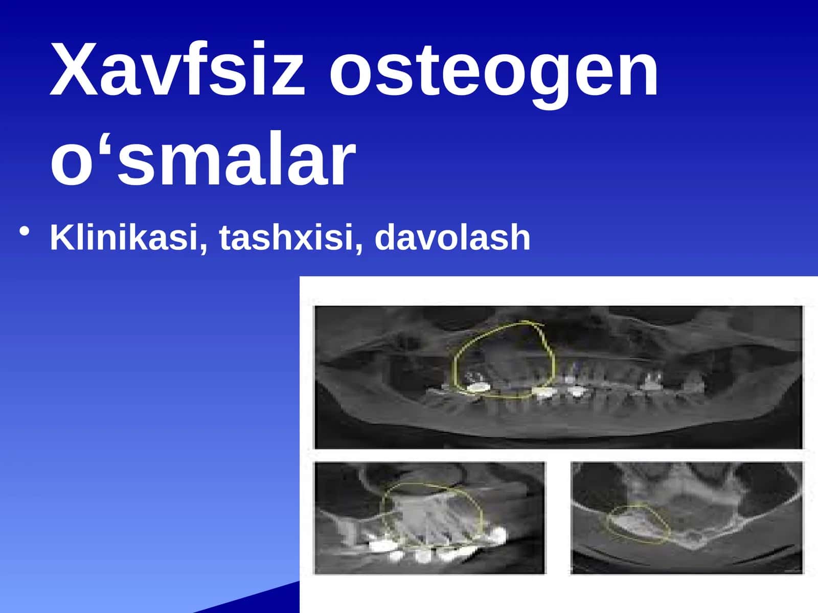 Xavfsiz osteogen o‘smalar