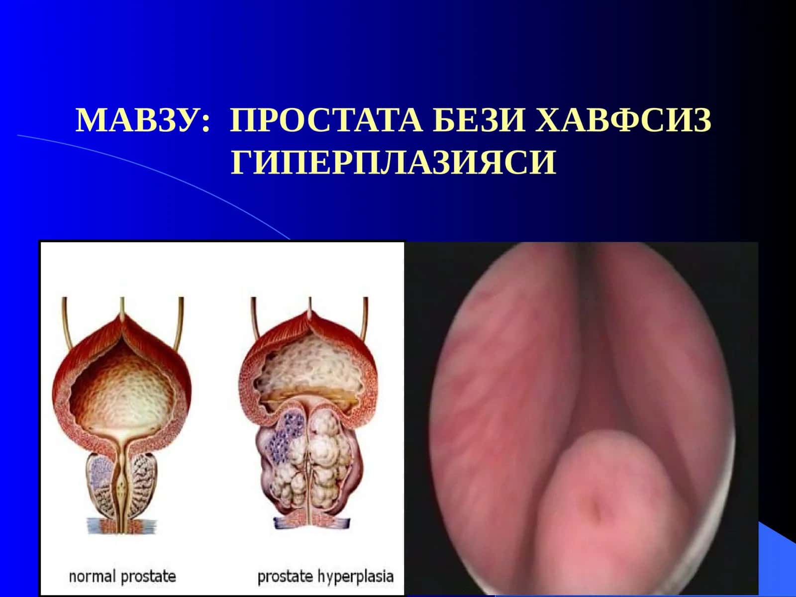 Простата бези хавфсиз гиперплазияси