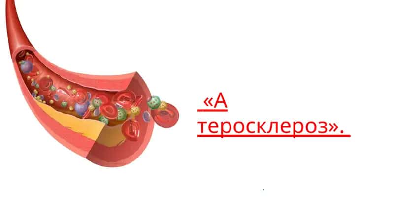 Атеросклероз
